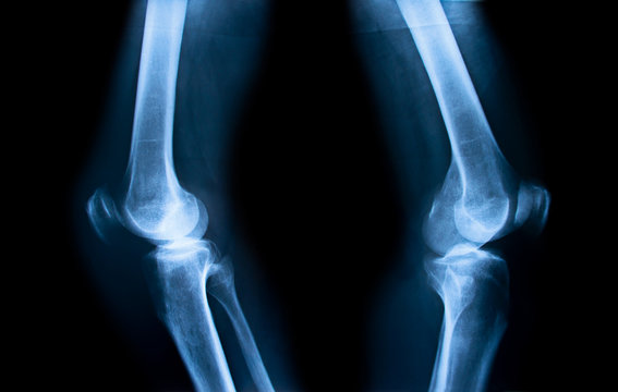Closeup of x-ray of human knees