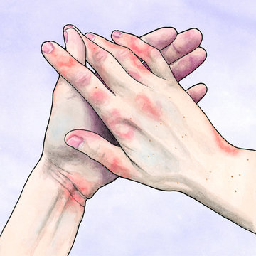 Hands – Eczema – Skin