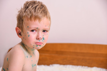 Young toddler,boy with chickenpox. Sick child with chickenpox. Varicella virus or Chickenpox bubble...