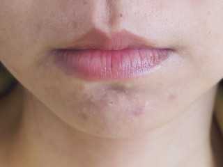 acne scars and hyperpigmentation under mouth using for skincare and cosmetics or beauty product concept.