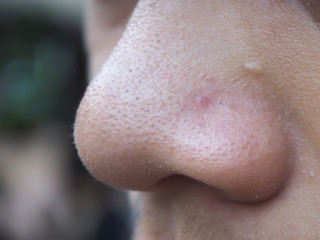 Fototapeta premium blackhead and pimple on the nose in man cause of oily face skin and large pore using for skincare and cleansing or beauty product concept.