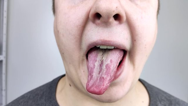 White curd on the tongue. A physician or gastroenterologist examines a man&rsquo;s tongue. Patient has poor oral hygiene or a symptom of illness