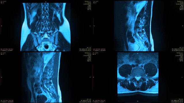 split screen of four MRI images