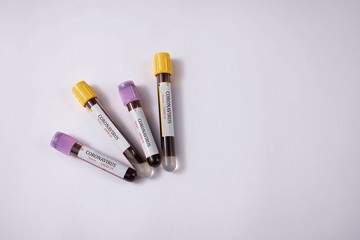 Blood Sample in a flask for analyzing Corona virus and producing vaccine. Corona virus outbreaking.