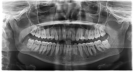 Panoramic x-ray of the jaw of a woman 28 years old. Healthy wisdom teeth.