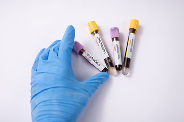 Blood Sample in a flask for analyzing Corona virus and producing vaccine. Corona virus outbreaking.
