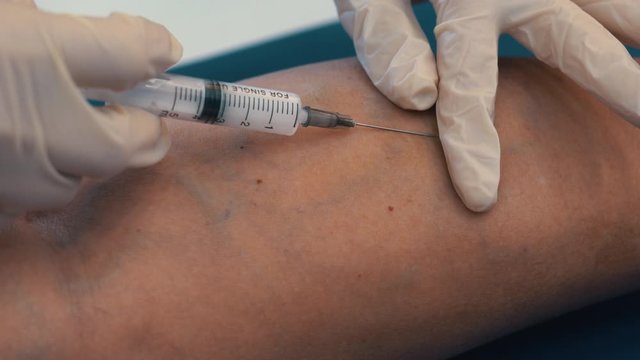 Treatment of varicose veins with injections. An injection into a vein in the leg. Dilated varicose veins in the legs