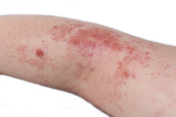 Eczema on the elbow