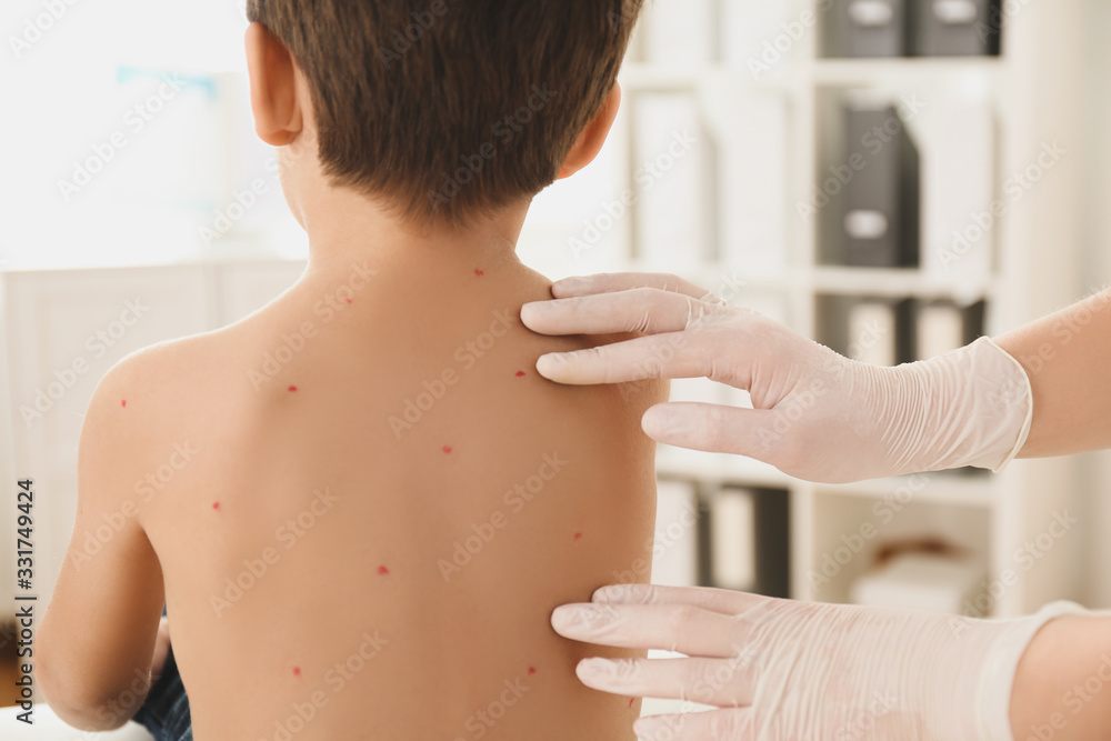 Poster Doctor examining little boy with chickenpox in clinic, closeup. Varicella zoster virus