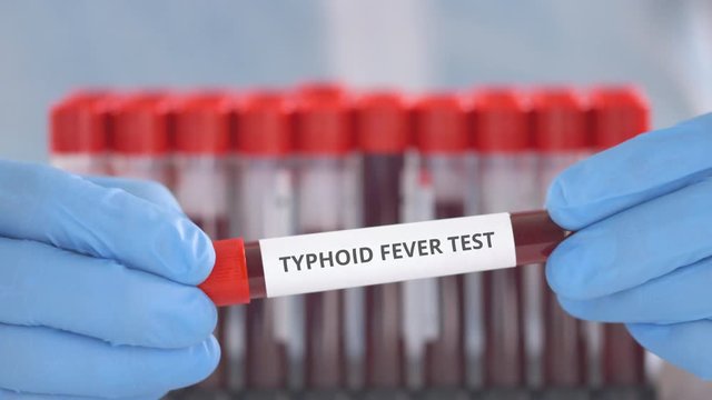 Laboratory assistant wearing protection gloves holds vial with typhoid fever test