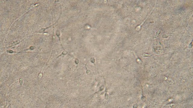 Microscopy of human sperm . Magnification 300x moving of spermatozoides in detail under microscope.