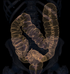 CT colonography  3D Rendering image