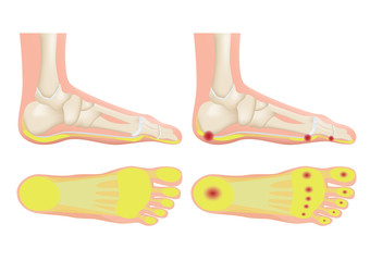 normal foot and a foot with a fat pad atrophy / callus © gritsalak