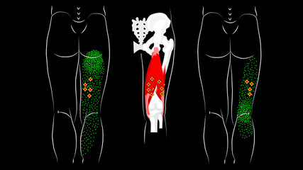 Trigger points and reflected pain in the hamstring muscles.