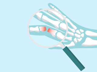 Use a magnifying glass on Broken finger bone illustration in x-ray style for Emergency accident injury concept.
