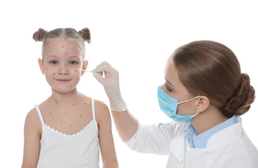Doctor applying cream onto skin of little girl with chickenpox against white background. Varicella...