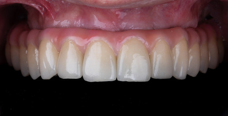 mounted prosthesis made of titanium and ceramic for the upper jaw © Dental Pro Content