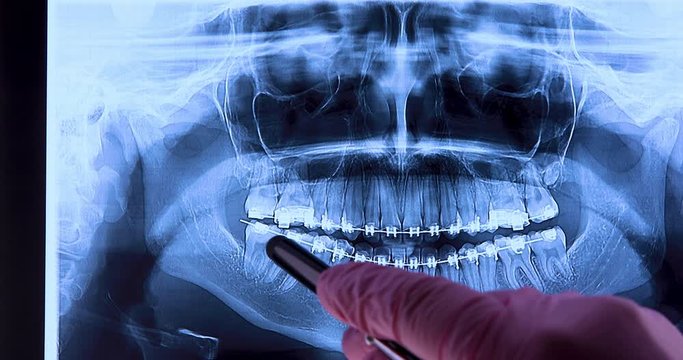 Stomatologist analyzing dental x-ray with braces. Radiography for teeth straightening and dental structures research concept. Dolly shot 4k