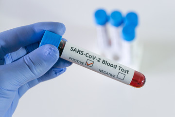 Obraz premium Positive blood test result for SARS CoV 2, coronavirus causing Covid 19 disease