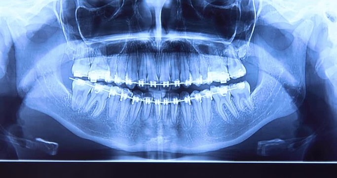 Dental x-ray with braces. Radiography for teeth straightening and dental structures research concept. The footage is out of focus and zooming comes in focus. Dolly shot 4k closeup