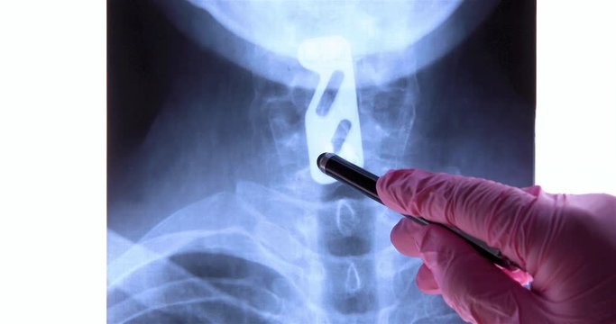 Doctor analyzing radiography of titanium plate fixation to support the cervical spine after C5 and C6 vertebrae injury. Provide neck stability using spinal instrumentation concept. Dolly shot 4k