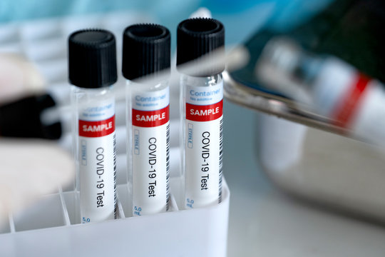 Multiple swab samples testing for COVID-19. Coronavirus pandemic tests.