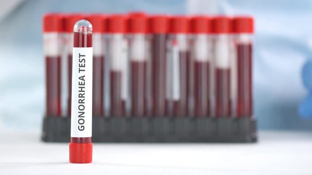 Hand wearing protection glove puts vial with gonorrhea test on the table