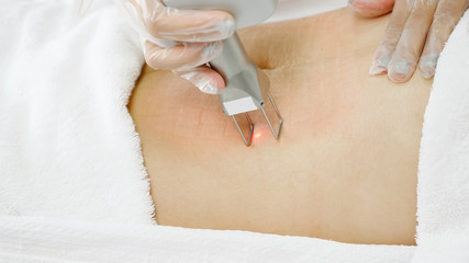 experienced therapist removes hair on beauty salon client belly with special white metal laser equipment extreme closeup