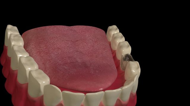 Tooth Extraction
