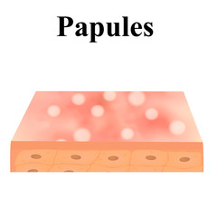 Papules. Acne on the skin. Dermatological and cosmetic diseases on the skin of the face acne. Infographics. Vector illustration on isolated background.
