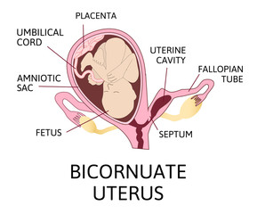 Obraz premium Bicornuate uterus and pregnancy. One uterine with fetus, child. Second uterine cavity is empty and separeted with septum.