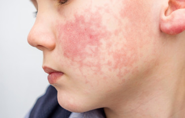 Boy with red cheeks- diathesis or allergy symptoms. Redness and peeling of the skin on the face.  - obrazy, fototapety, plakaty