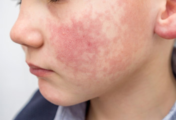 Boy with rosy red cheeks- diathesis, enterovirus infection or allergy symptoms. Redness and peeling...