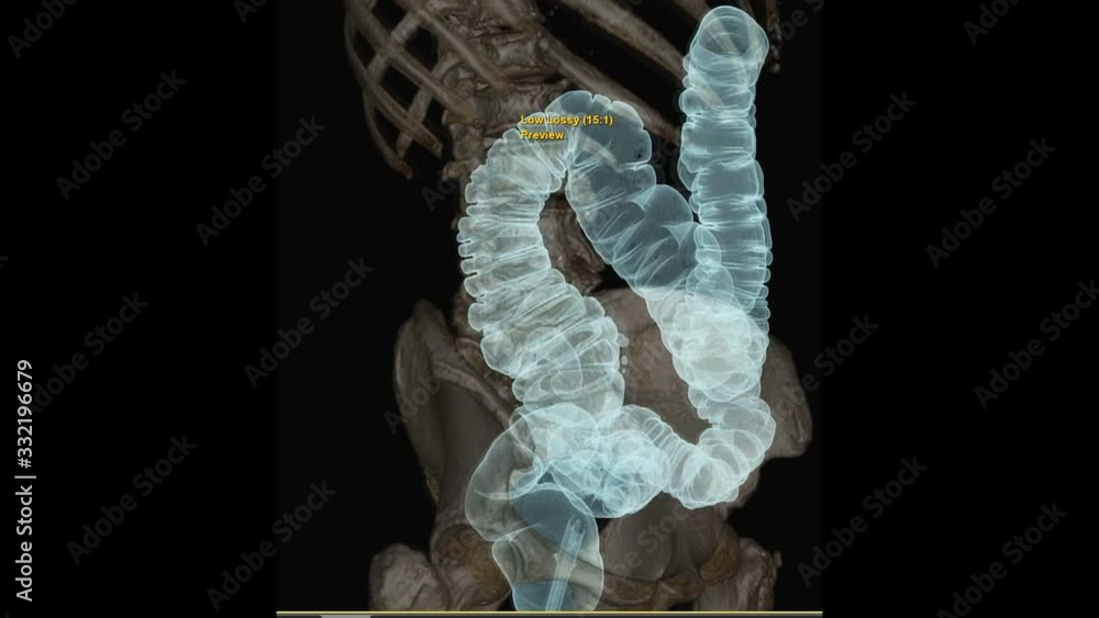 Aufkleber ct colonography or ct scan of colon 3d rendering image with transparent bone showing anatomical colo