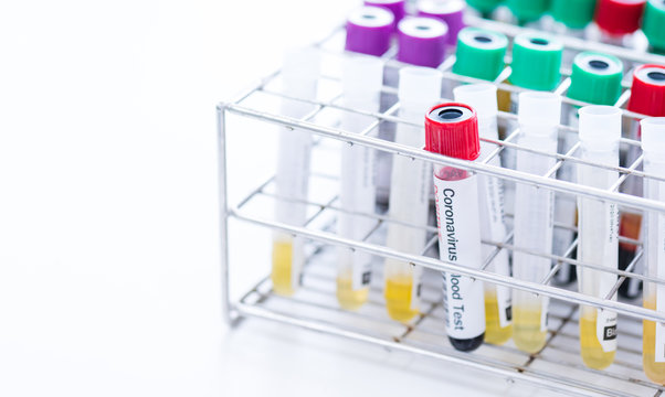 Blood test tube  for laboratory analysis.Laboratory testing patient’s blood samples.Conceptual image coronavirus (COVID-19) test tube sample that has tested positive for coronavirus.