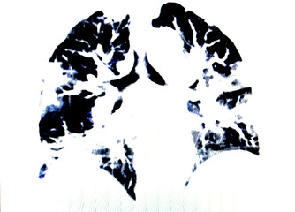 Obraz na płótnie Canvas COVID-19 Coronal CT Scan of the Chest