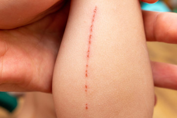 wounds, scratches, abrasions on the child’s hand, wrist, forearm close-up