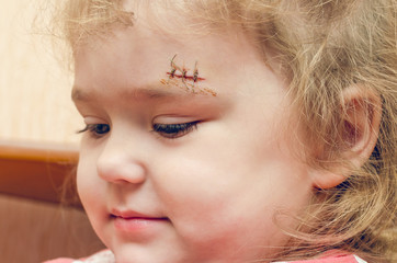 A little girl with a scar above her eyebrow, a deep wound sewn up