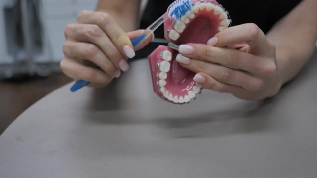 A woman brushes teeth with braces