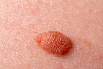 Large mole close-up. Macro shot of benign skin lesion on caucasian, human skin. Proliferation of pigment derma cells, melanocytic pigmented naevus, naevocytic nevus. Skin screening, cosmetic surgery