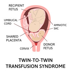 Fototapeta premium Twin-to-twin transfusion syndrome, feto-fetal transfusion syndrome. disproportionate blood supply. Two fetuses in womb, one bigger recipient, one smaller donor. pregnancy pathology.
