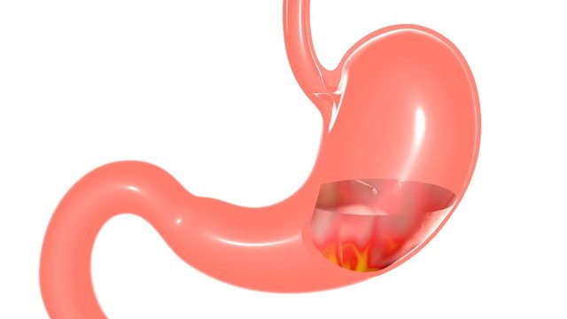 Anatomical 3D animation of heartburn. Graphic representation of the effect of digestion with content. Image isolated on white background.