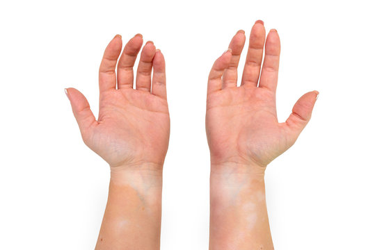 Stains from vitiligo disease on the inside of the hands and forearms of a young Caucasian woman, isolated on a white background with a clipping path.