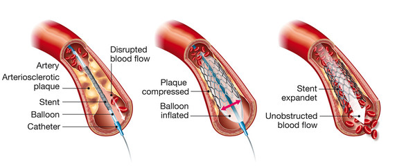 Arteriosclerosis, balloon angioplasty and stent insertion, medical illustration, labeled