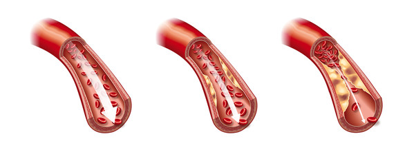 Arteriosclerosis, illustration showing healthy blood vessel and beginning of arteriosclerosis - obrazy, fototapety, plakaty