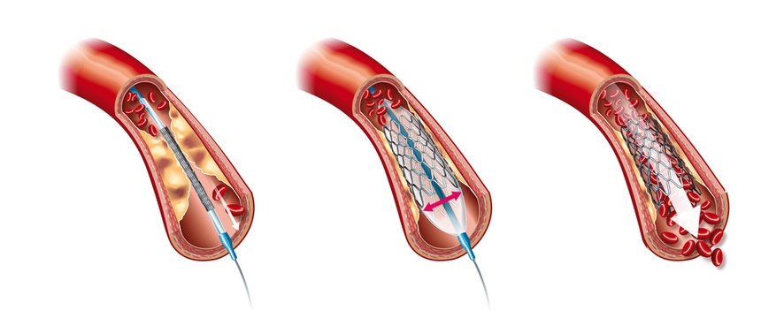 Arteriosclerosis, balloon angioplasty and stent insertion, medical illustration, labeled
