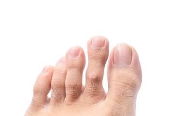 Close up of male foot and dirty long toe nail isolated on white background with clipping path. medical foot and cleanliness concept.
