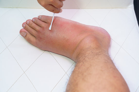 Close up old man right foot, Ankle wounded waiting and swelling infectious disease by bee sting allergic reactions nurse treatment on wound dressing a bloody and brine of patient on white background.