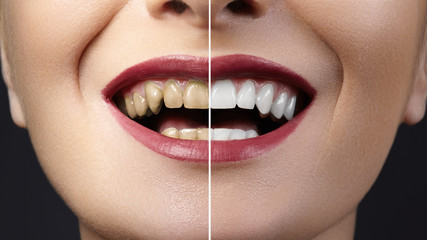 Before and after whitening treatment or dental veneers on teeth. Health Care collage of human mouth. Caries therapy