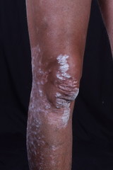 skin diseases - psoriasis on the legs